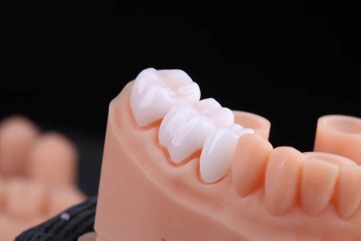Coroas de cerâmica sobre modelo de trabalho