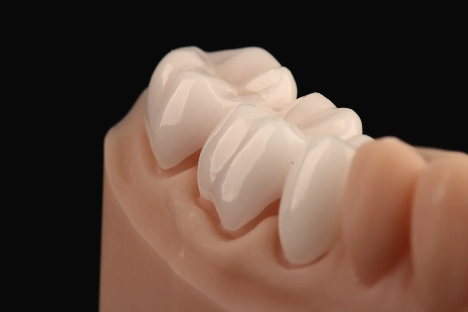 Coroas de porcelana feitas para um caso do consultório