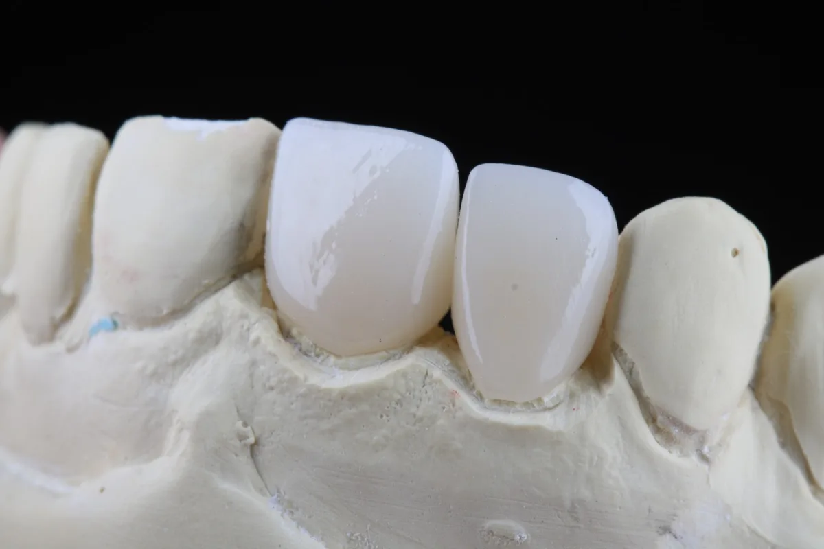Lentes de contato de cerâmica em modelo de gesso