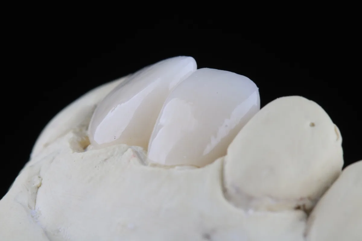 Coroa unitária de cerâmica em modelo